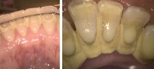 Before and after image of common dental issues