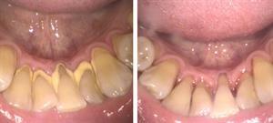 Before and after image of common dental issues