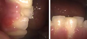Before and after image of common dental issues